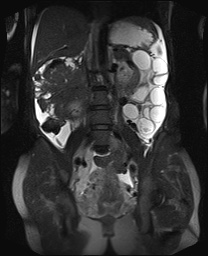 File:Closed loop small bowel obstruction in pregnancy (MRI) (Radiopaedia 87637-104031 Coronal T2 fat sat 35).jpg