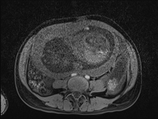 Closed loop small bowel obstruction in pregnancy (MRI) (Radiopaedia 87637-104031 F 18).jpg