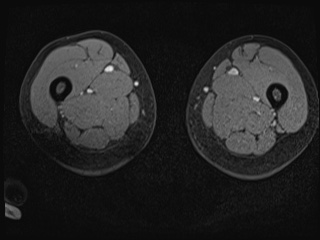 Closed loop small bowel obstruction in pregnancy (MRI) (Radiopaedia 87637-104031 G 69).jpg