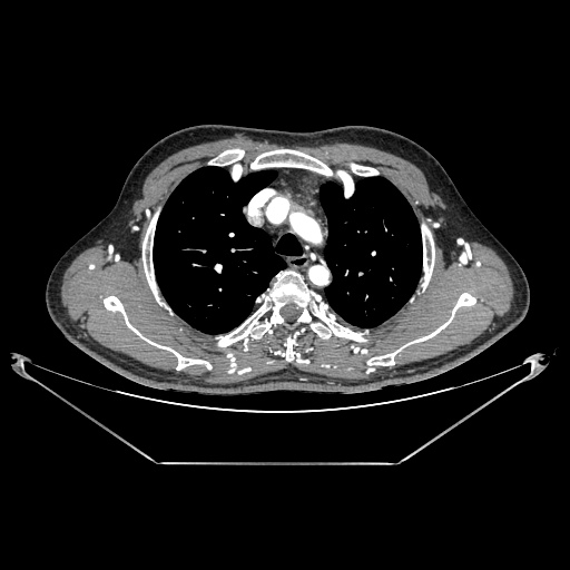 Coarctation of aorta (Radiopaedia 25384-25630 A 34).jpg