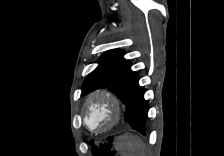 Coarctation of aorta with aortic valve stenosis (Radiopaedia 70463-80574 B 221).jpg