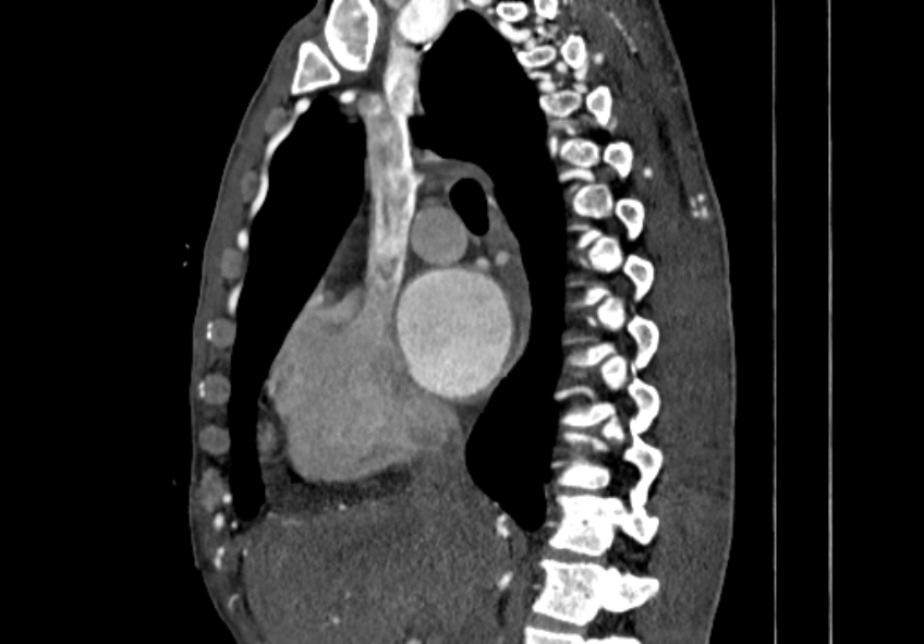 Coarctation of aorta with aortic valve stenosis (Radiopaedia 70463-80574 B 27).jpg