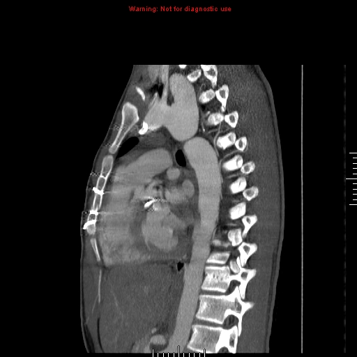File:Coarctation of the aorta (Radiopaedia 9434-10118 B 33).jpg