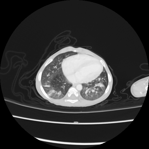 Coarctation of the aorta and patent ductus arteriosus (Radiopaedia 68033-77499 Axial lung window 44).jpg