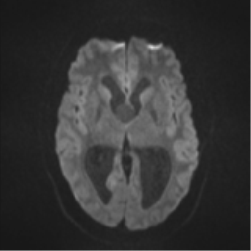 Colloid cyst (Radiopaedia 53164-59125 Axial DWI 41).png