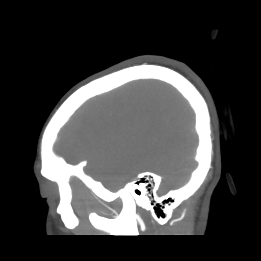 Colloid cyst (resulting in death) (Radiopaedia 33423-34499 B 47).png
