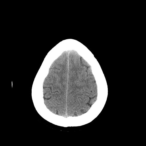File:Colloid cyst with anterior communicating artery aneurysm (Radiopaedia 33901-35090 Axial non-contrast 23).jpg