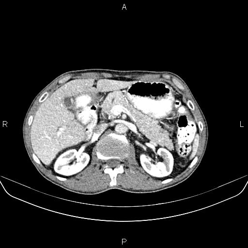 Colon adenocarcinoma - hepatic flexure (Radiopaedia 85635-101395 A 29).jpg