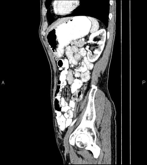 Colon adenocarcinoma - hepatic flexure (Radiopaedia 85635-101395 D 66).jpg