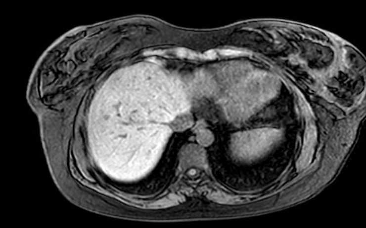 Colon adenocarcinoma with Krukenberg tumors, advanced pregnancy (Radiopaedia 67279-76645 A 75).jpg