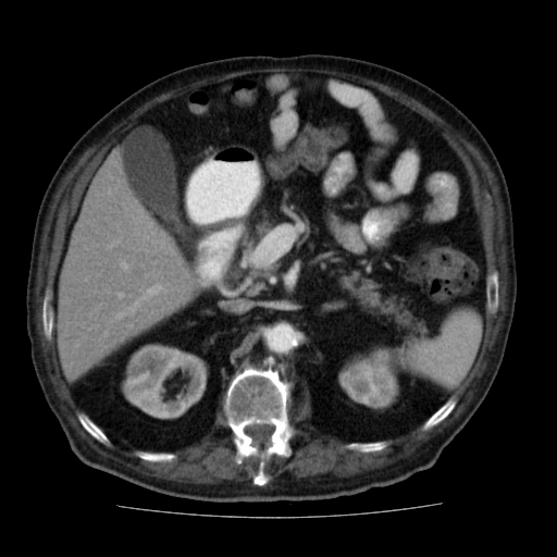 File:Colon cancer with duodenal invasion (Radiopaedia 16278-15958 A 20).jpg