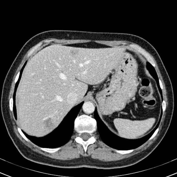 Colon carcinoma with hepatic metastases (Radiopaedia 29477-29961 A 20).jpg