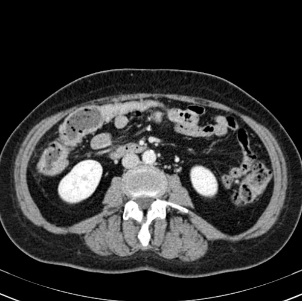 Colon carcinoma with hepatic metastases (Radiopaedia 29477-29961 A 58).jpg