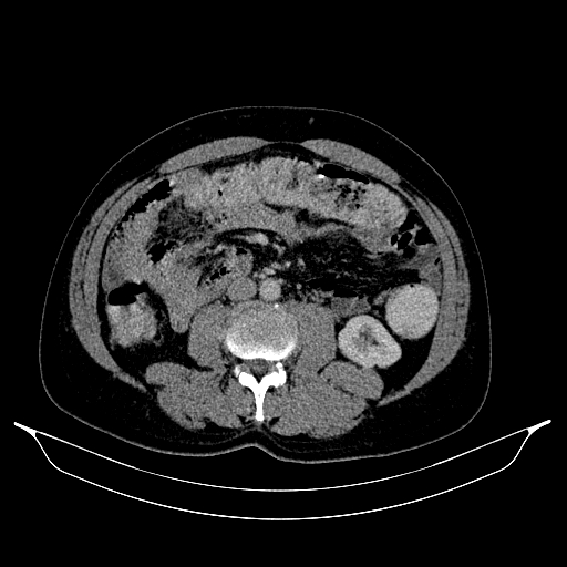 Colonic diverticulosis (Radiopaedia 72222-82744 A 16).jpg