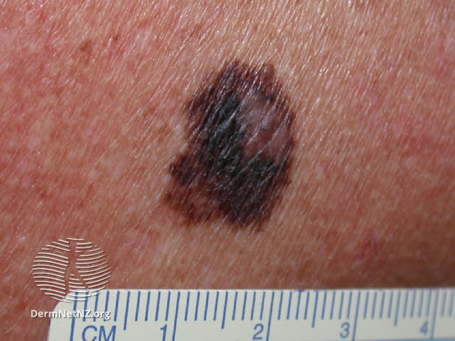 File:Diameter - 6 mm (DermNet NZ melanoma-abcd-04).jpg