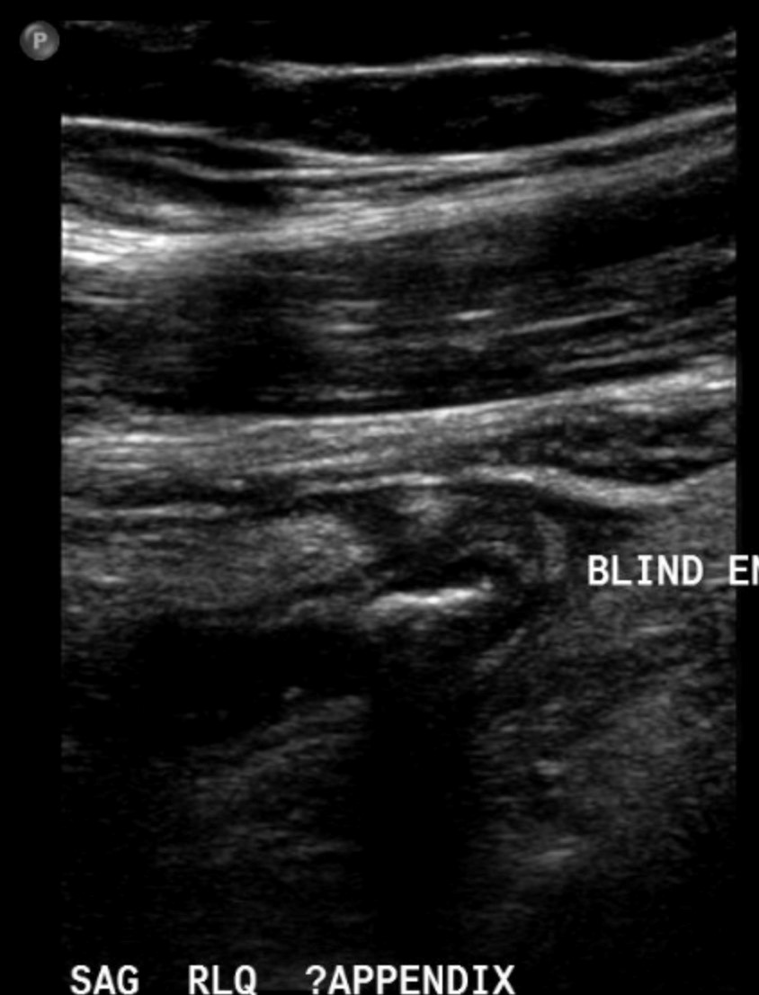 Figure 10.9B Child ultrasound of appendix, long axis, and blind end tubular structure with an appendicolith.jpg