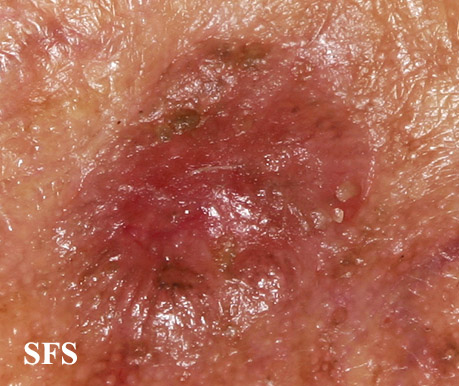 File:Melanoma (Dermatology Atlas 29).jpg