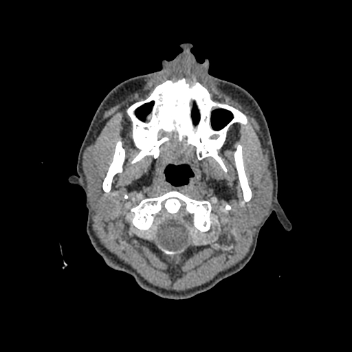 Nasal pyogenic granuloma (lobular capillary hemangioma) (Radiopaedia 85536-101244 C 4).jpg