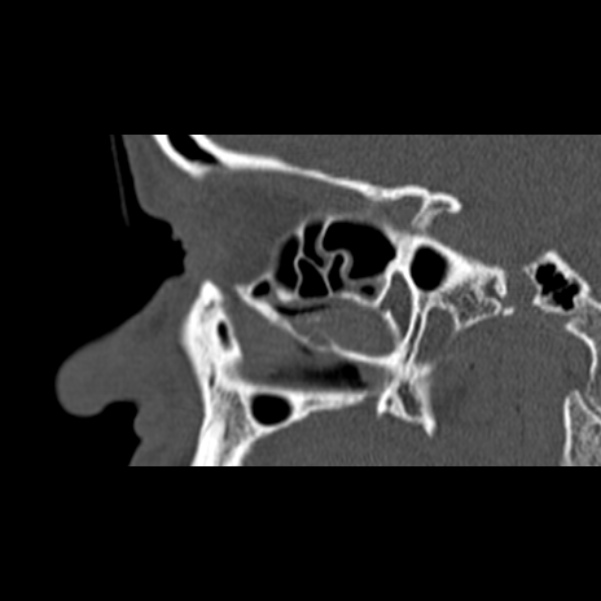 Nasal septal perforation (Radiopaedia 25030-25289 Sagittal bone window 10).jpg