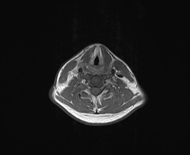 File:Nasopharyngeal carcinoma with perineural spread (Radiopaedia 55030-61380 Axial T1 10).jpg