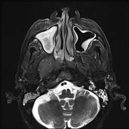 File:Nasopharyngeal carcinoma with skull base invasion (Radiopaedia 59258-66600 D 17).jpg
