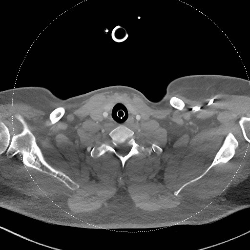 Neck CT angiogram (intraosseous vascular access) (Radiopaedia 55481-61945 B 121).jpg