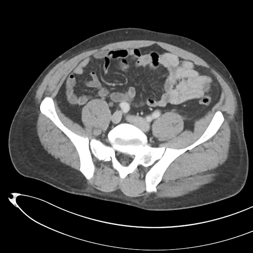 File:Necrotizing pancreatitis with acute necrotic collections (Radiopaedia 38829-41012 B 59).png