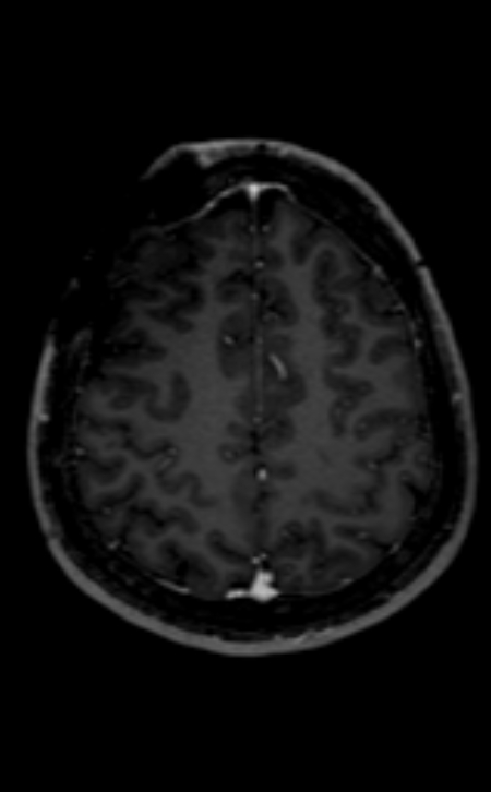 Neuro-Behçet disease (Radiopaedia 90112-107294 Axial T1 C+ 82).jpg