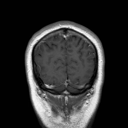 File:Neuro-Behcet's disease (Radiopaedia 21557-21505 Coronal T1 C+ 20).jpg