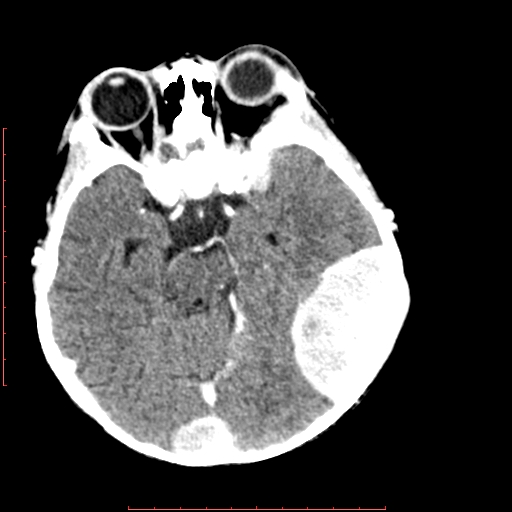 File:Neuroblastoma skull metastasis (Radiopaedia 56053-62683 Axial +Contrast 7).jpg