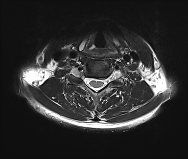File:Neurofibromatosis type 1 (Radiopaedia 80355-93740 Axial T2 14).jpg