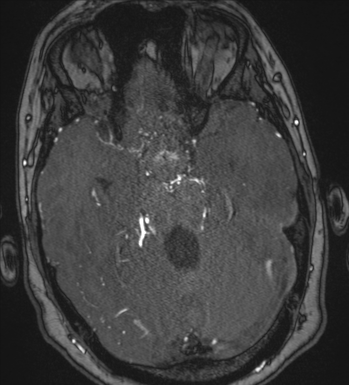 Neurofibromatosis type 1 - head and neck - CNS manifestations (Radiopaedia 49910-55188 Axial MRA 29).png