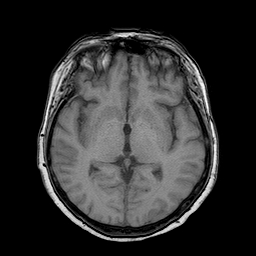 File:Neurofibromatosis type 2 (Radiopaedia 8713-9518 Axial T1 13).jpg