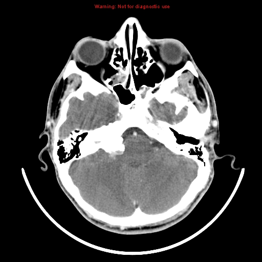 File:Neurofibromatosis type 2 (Radiopaedia 8953-9732 C 6).jpg