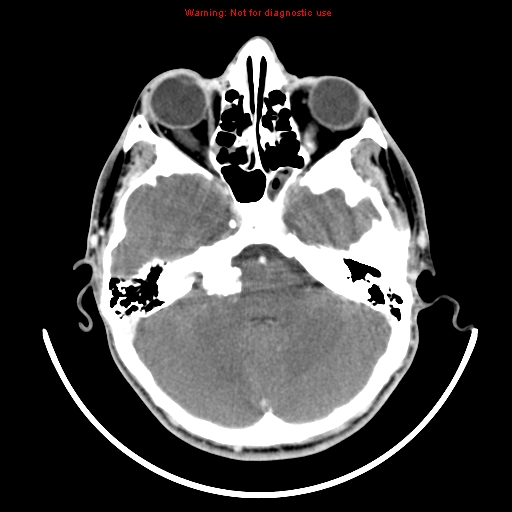 File:Neurofibromatosis type 2 (Radiopaedia 8953-9732 C 7).jpg