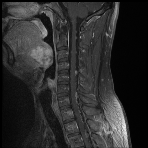 File:Neurofibromatosis type 2 (spinal manifestations) (Radiopaedia 53943-60070 G 7).png