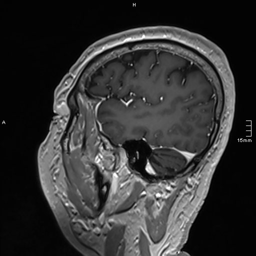 Neurosarcoidosis - involvement of the mesial temporal lobes (Radiopaedia 67429-76820 Sagittal T1 C+ 133).jpg