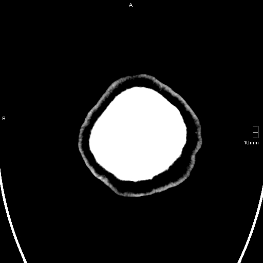 File:Neurotoxoplasmosis - concentric target sign (Radiopaedia 70644-80783 Axial non-contrast 43).jpg