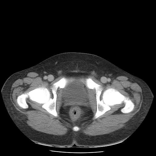 File:Non-Hodgkin lymphoma involving pelvis (Radiopaedia 21281-21197 A 60).jpg