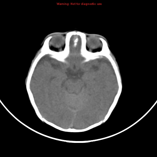 File:Non-accidental injury - bilateral subdural with acute blood (Radiopaedia 10236-10765 Axial non-contrast 8).jpg