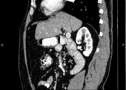 Non-syndromic pancreatic endocrine tumor (Radiopaedia 86958-103178 E 40).jpg