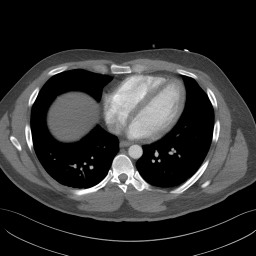 File:Normal CTA thorax (non ECG gated) (Radiopaedia 41750-44704 A 64).png