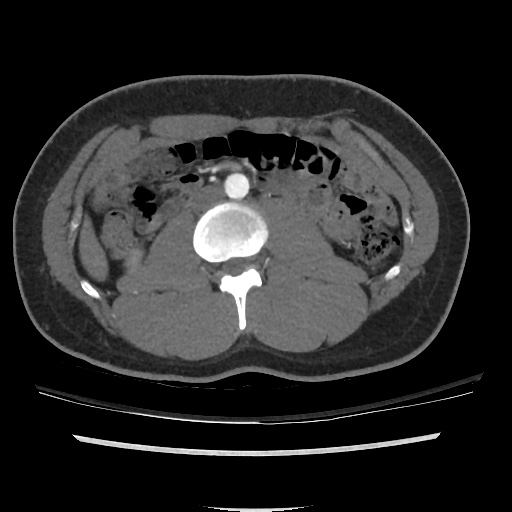 File:Normal CT angiogram of pelvis (Radiopaedia 45390-49430 A 3).jpg
