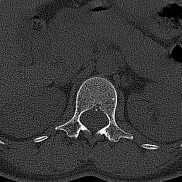 File:Normal CT lumbar spine (Radiopaedia 53981-60118 Axial bone window 12).jpg