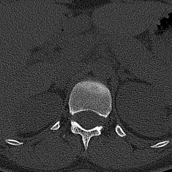 File:Normal CT lumbar spine (Radiopaedia 53981-60118 Axial bone window 4).jpg