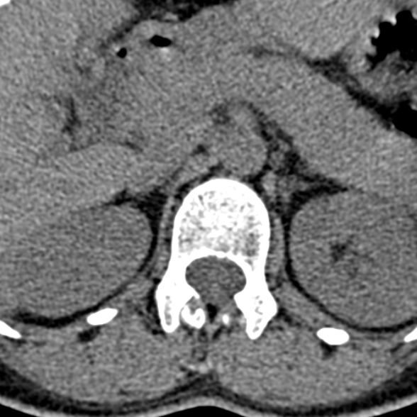 Normal CT lumbar spine (Radiopaedia 53981-60118 Axial non-contrast 15).jpg