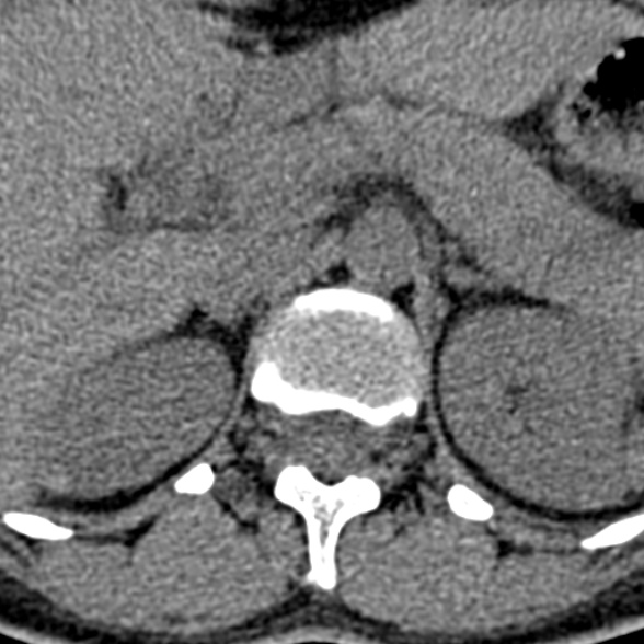 Normal CT lumbar spine (Radiopaedia 53981-60118 Axial non-contrast 9).jpg