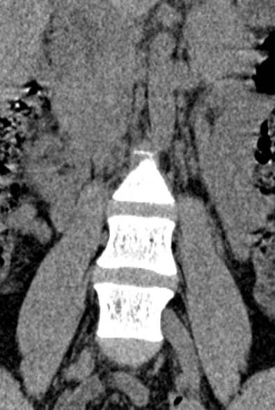Normal CT lumbar spine (Radiopaedia 53981-60118 F 13).jpg