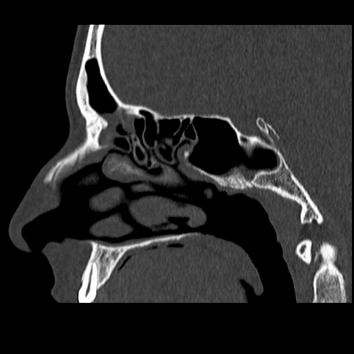 Normal CT paranasal sinuses (Radiopaedia 42286-45390 Sagittal bone window 56).jpg