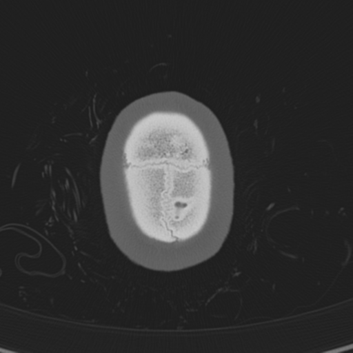 Normal CT skull (Radiopaedia 40798-43459 A 151).png